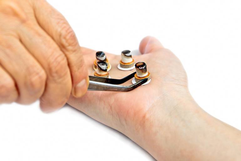 Moxibustion pic via Shutterstock.